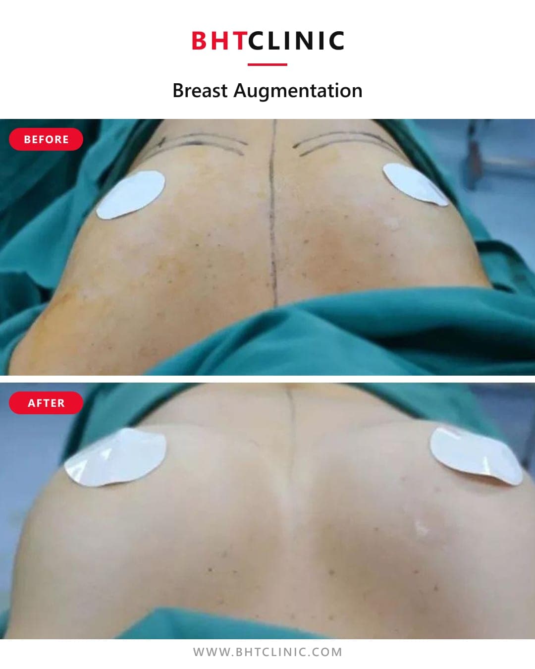 Augmentation — implant — before and after, photo 1