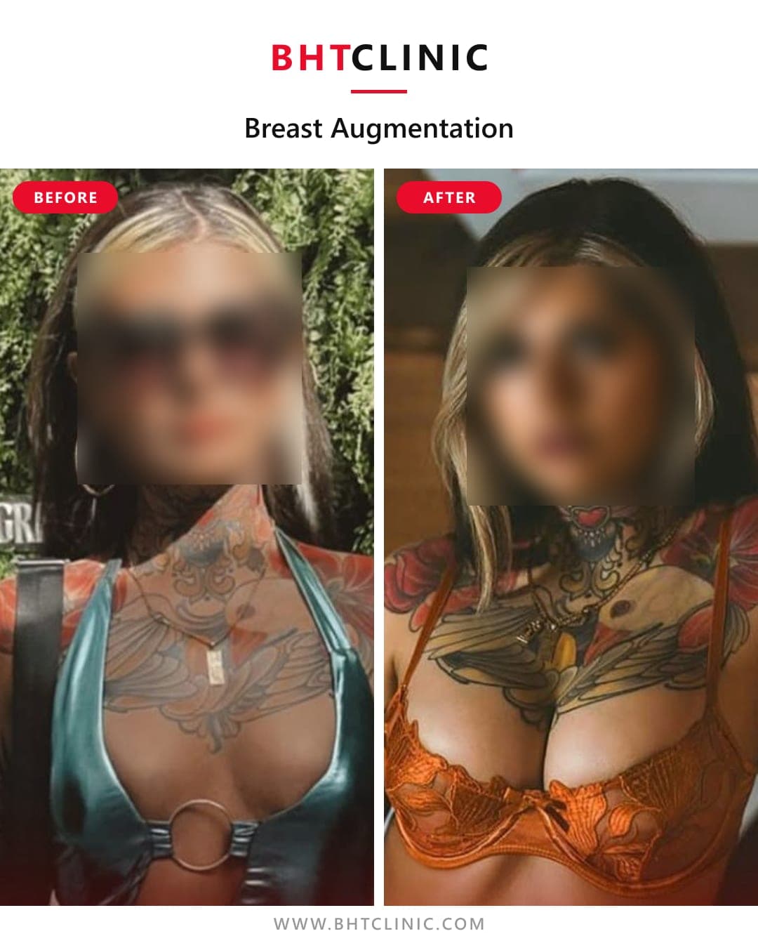 Augmentation — implant — before and after, photo 1