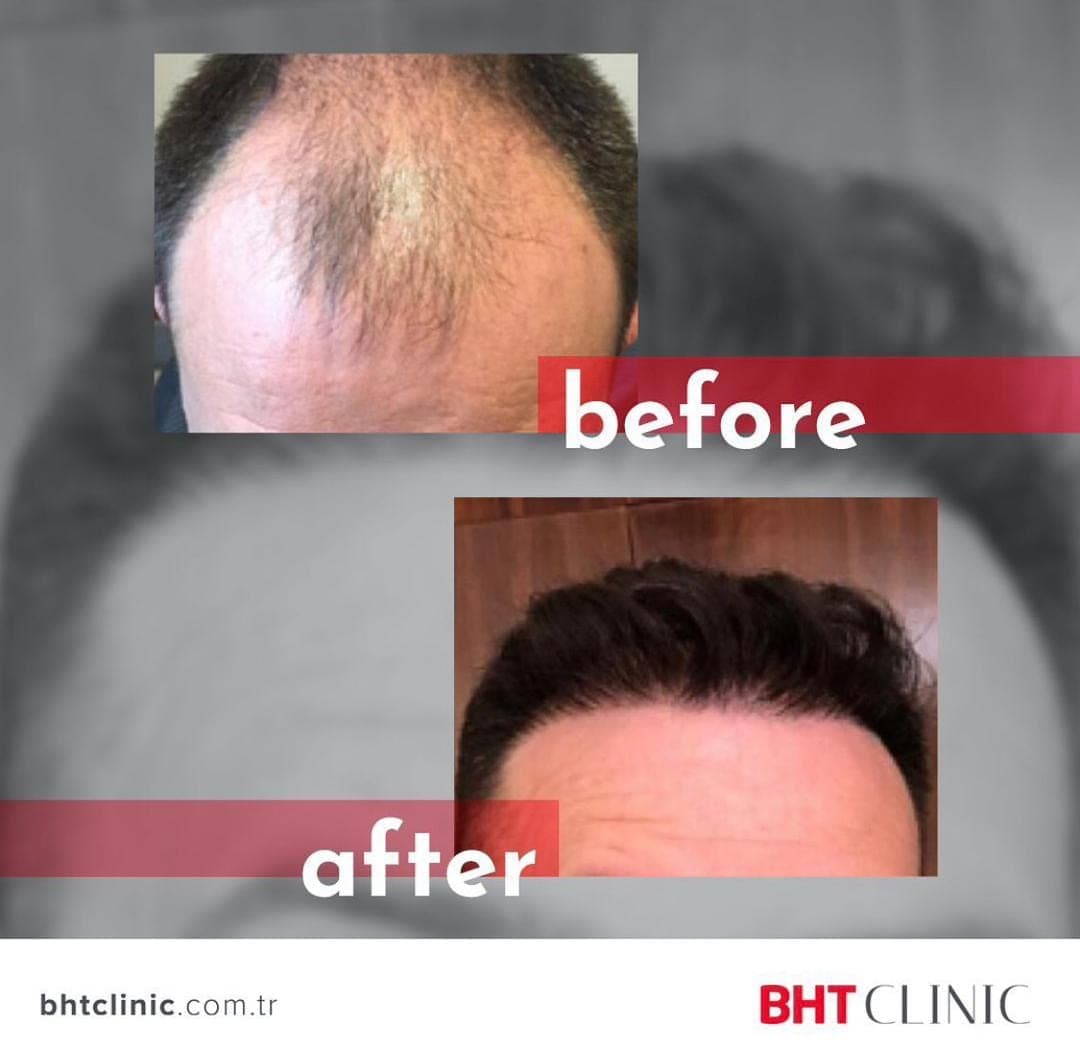 Receding hairline — before and after, photo 1