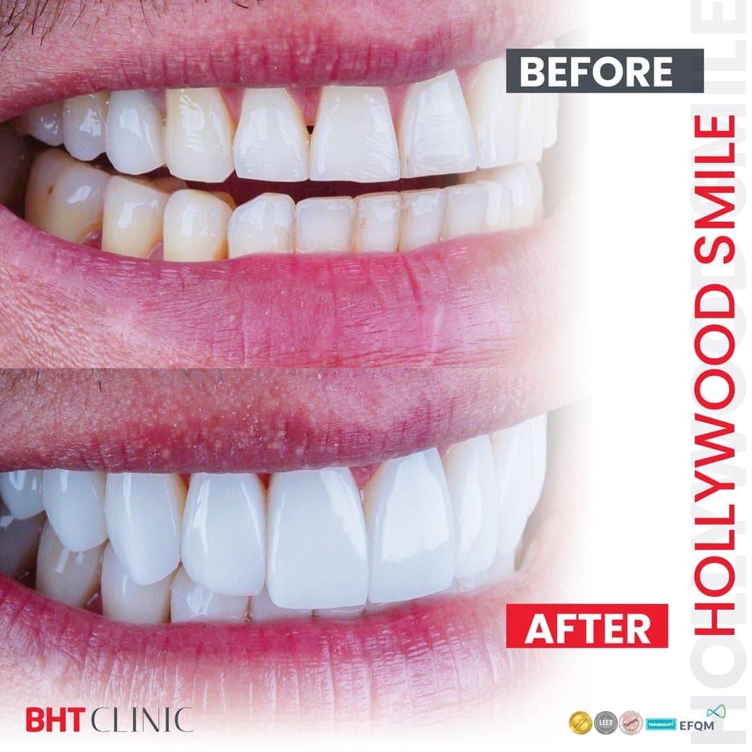 Smile makeover — shade and shape — before and after, photo 1