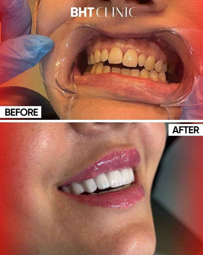 Smile makeover — alignment and shade — before and after, photo 1