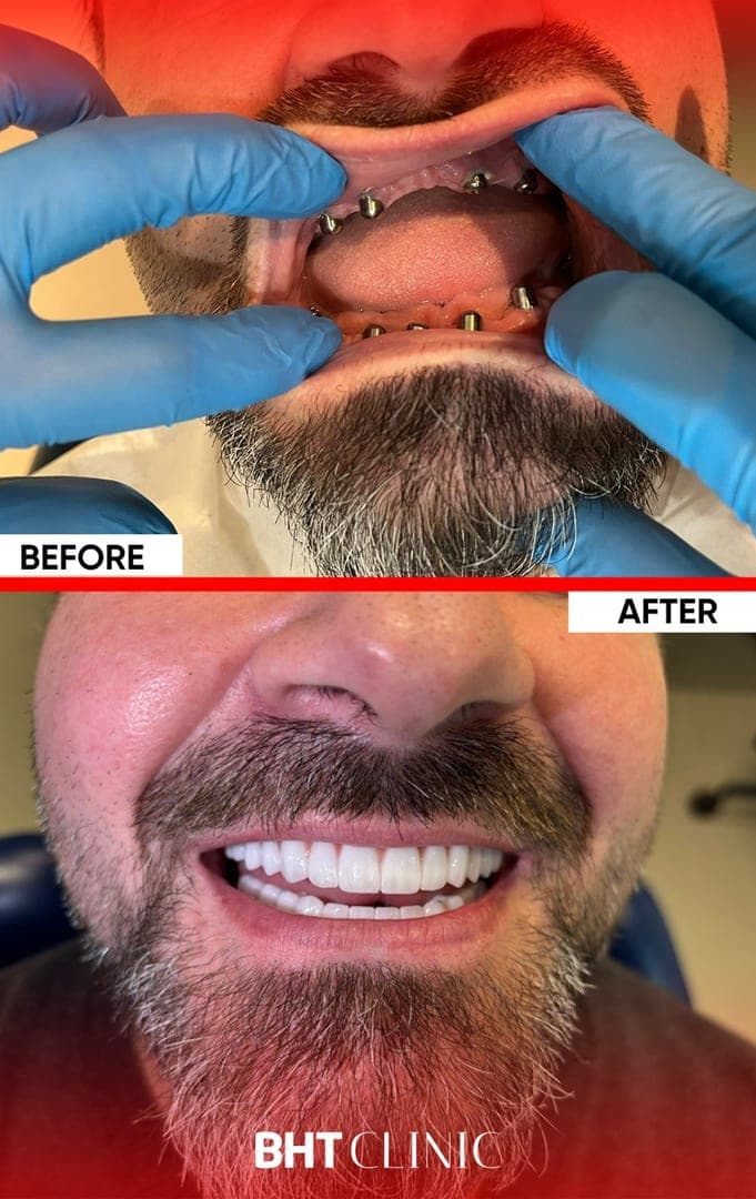 Full arch on implants — both jaws — before and after, photo 1
