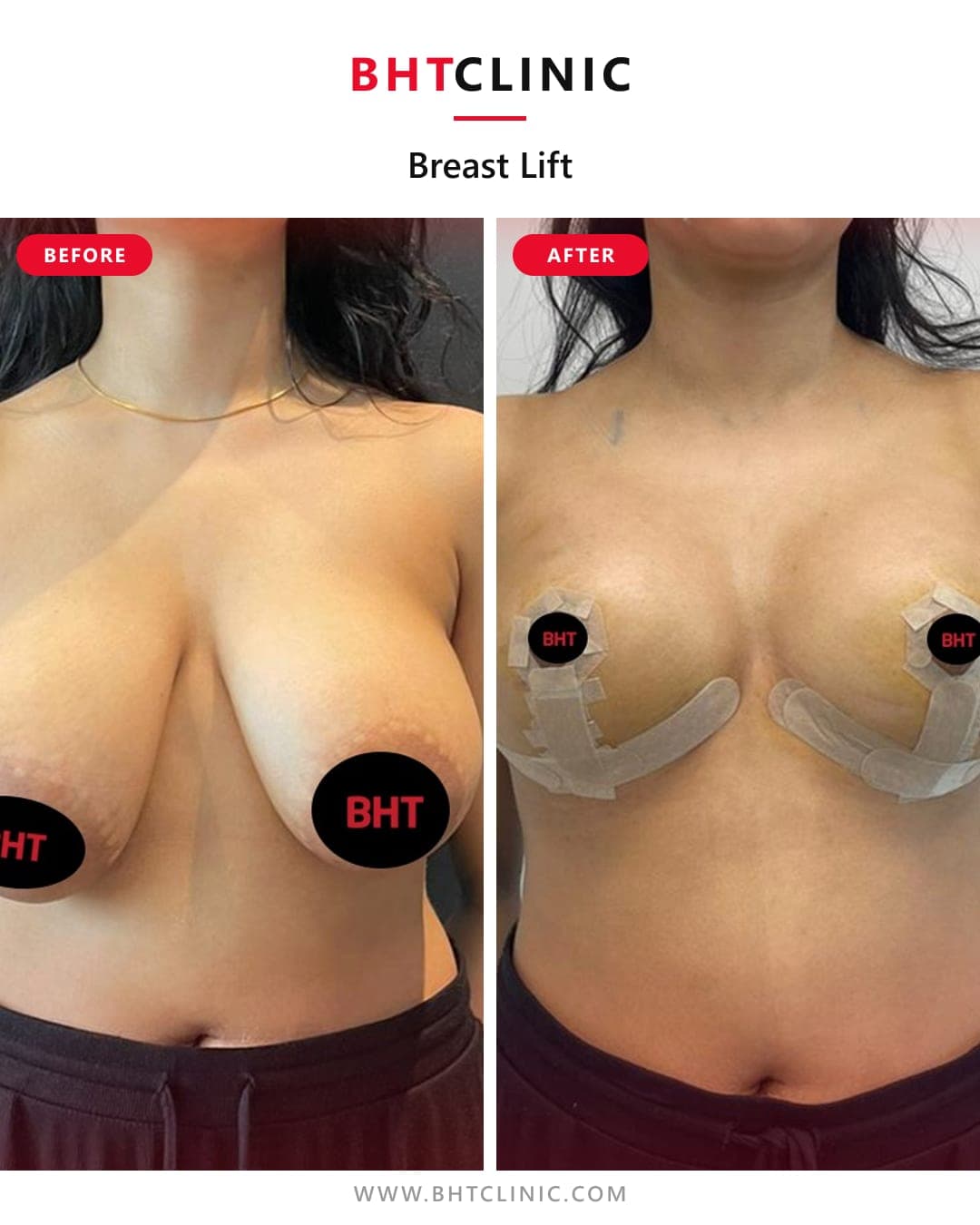 Breast lift — before and after, photo 1