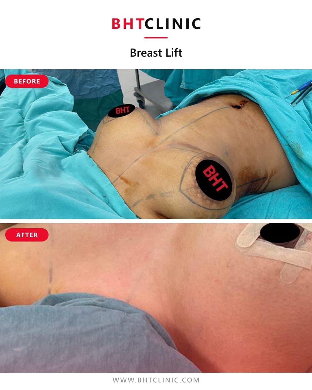 Breast lift — before and after, photo 1