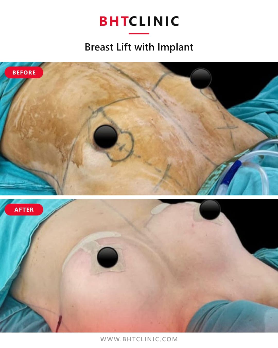 Lift with implant — before and after, photo 1
