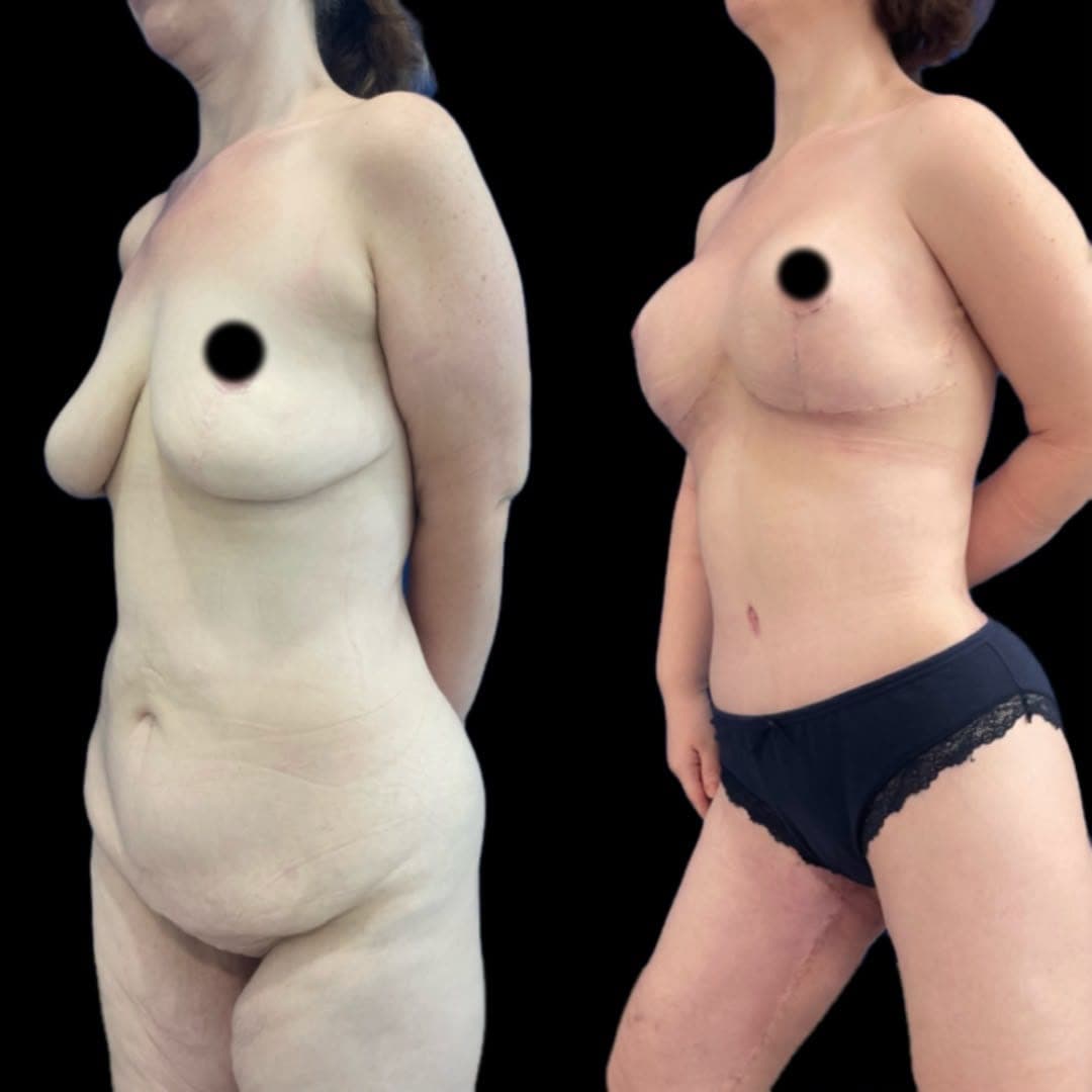 Abdomen and breast together — before and after, photo 1