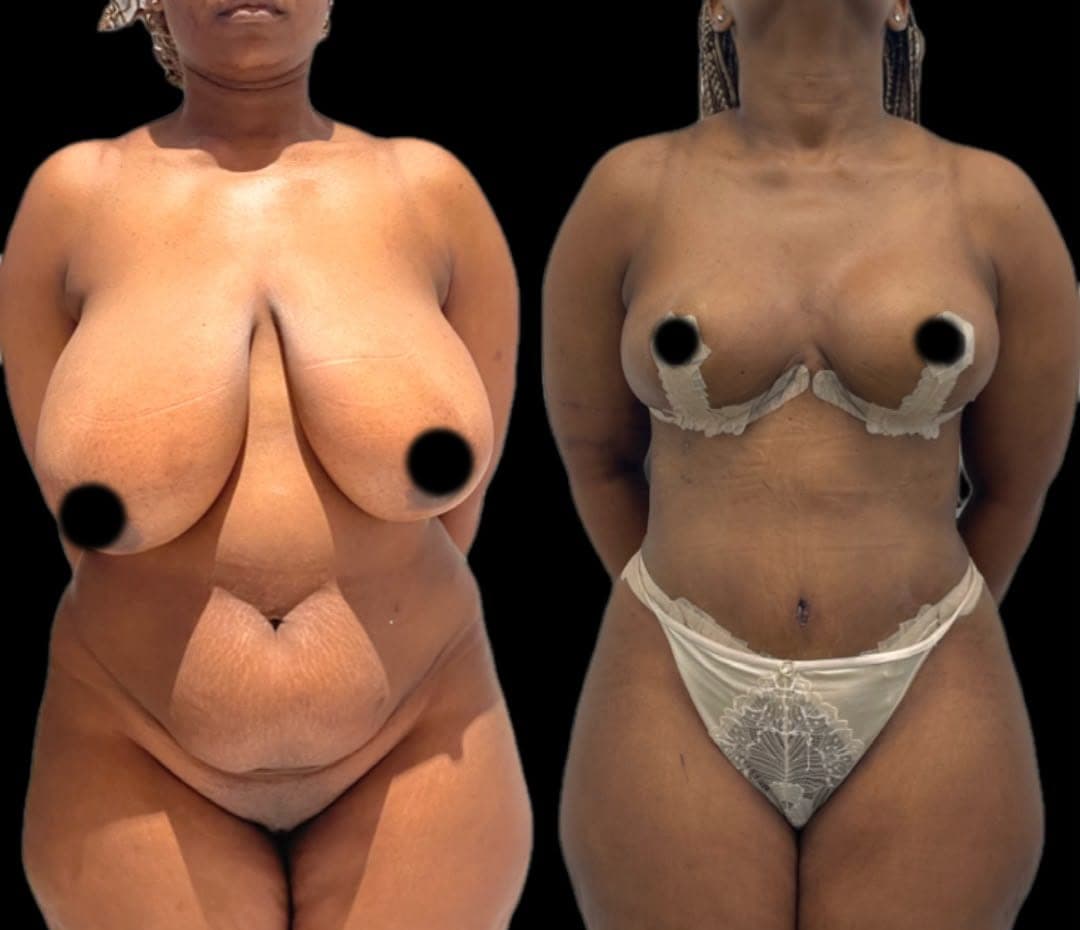 Reduction with abdominoplasty — before and after, photo 1