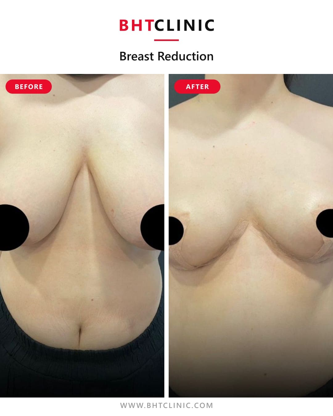Breast reduction — before and after, photo 1