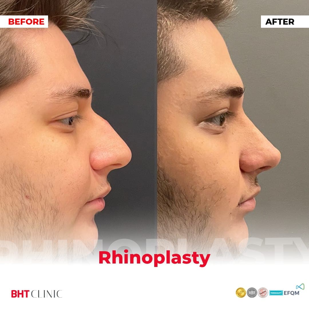 Dorsal hump — before and after, photo 1