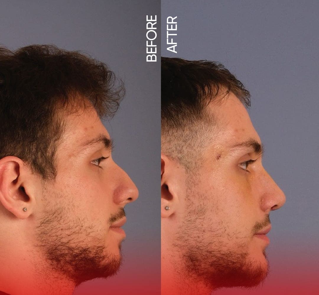 Bridge and tip together — before and after, photo 1