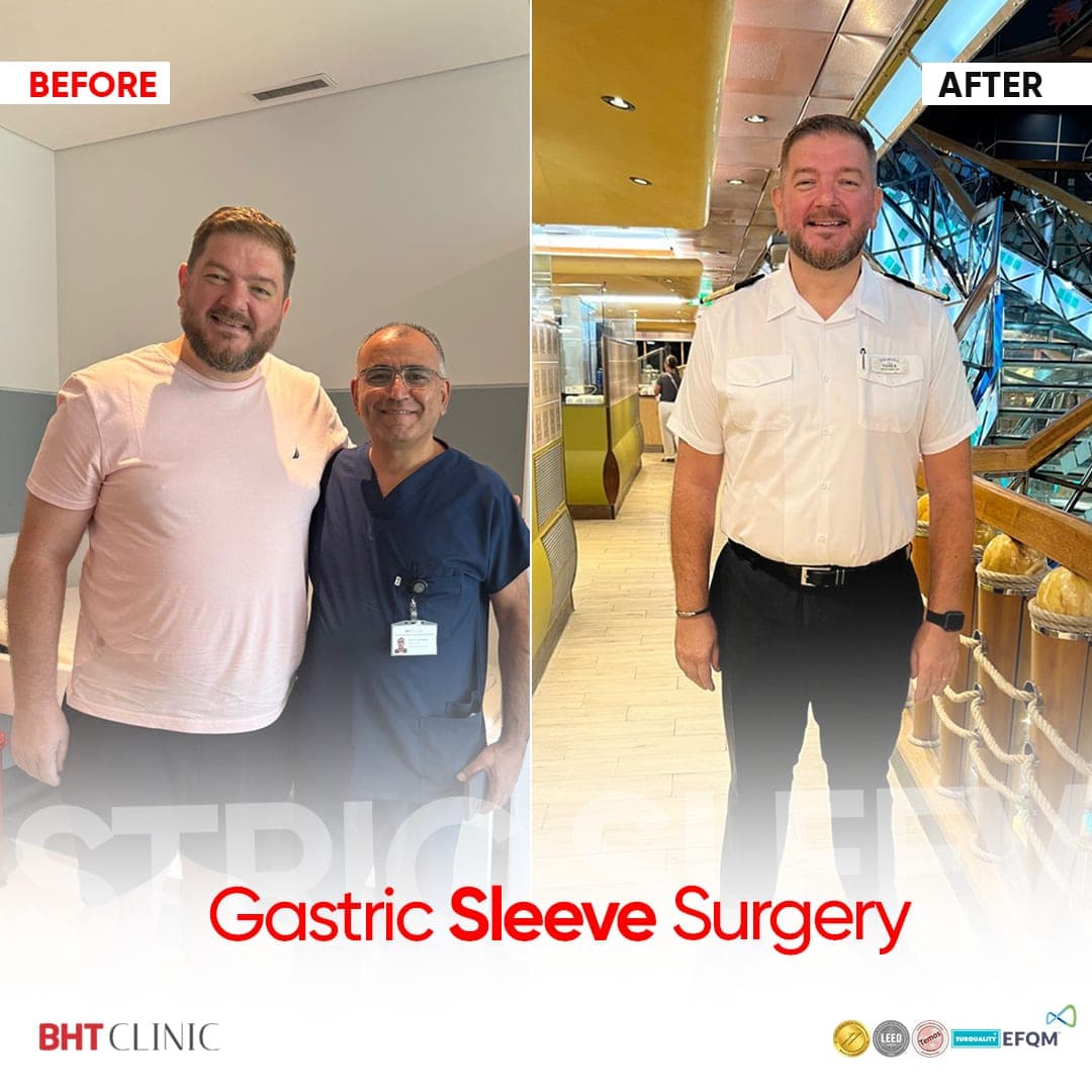 Gastric sleeve — before and after, photo 1