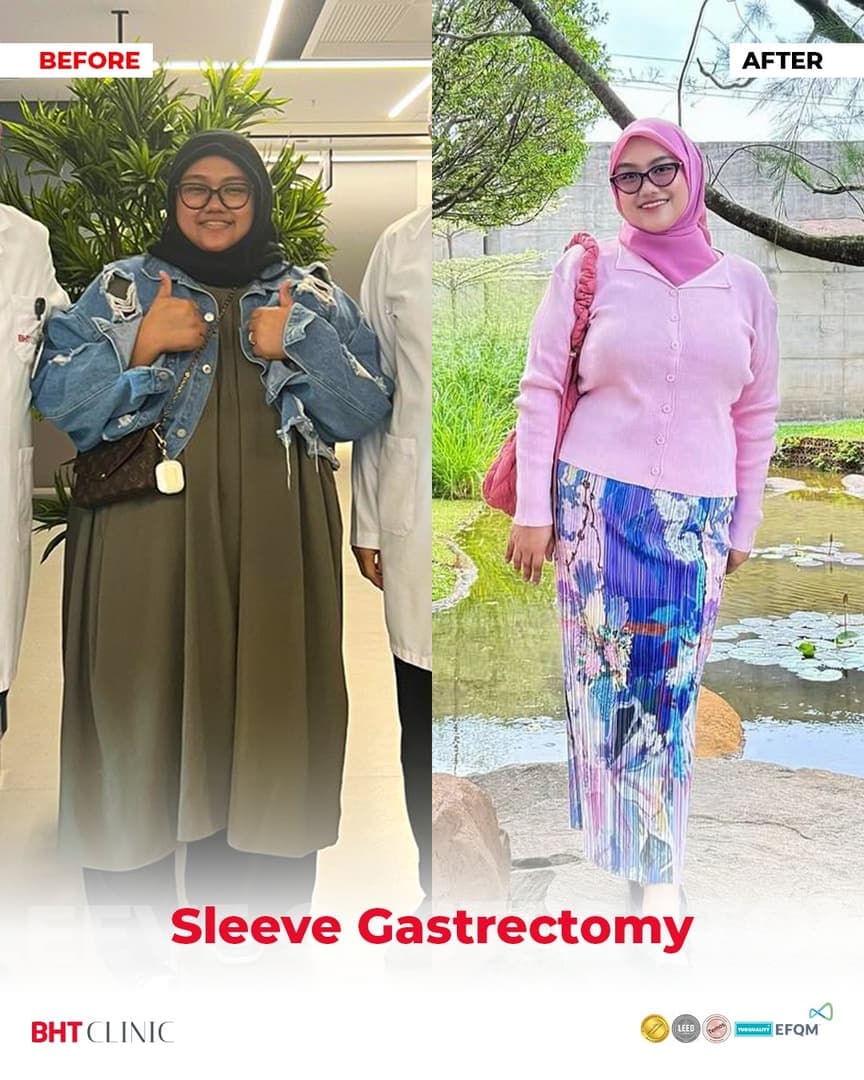 Sleeve gastrectomy — before and after, photo 1