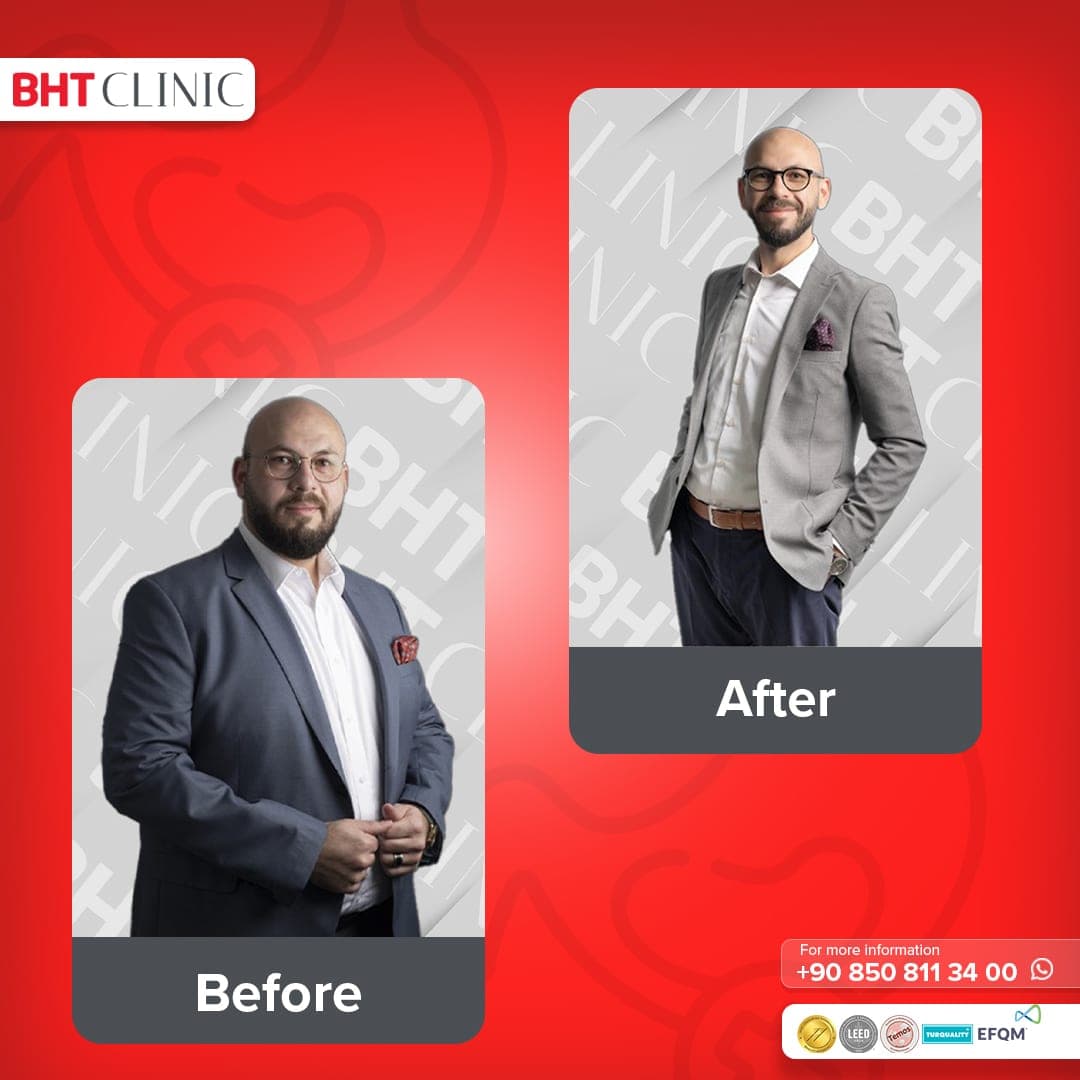Gastric sleeve — before and after, photo 1