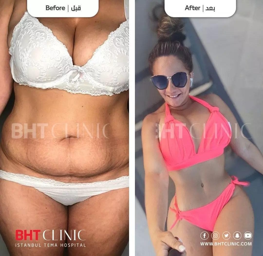 Abdomen and waistline — before and after, photo 1
