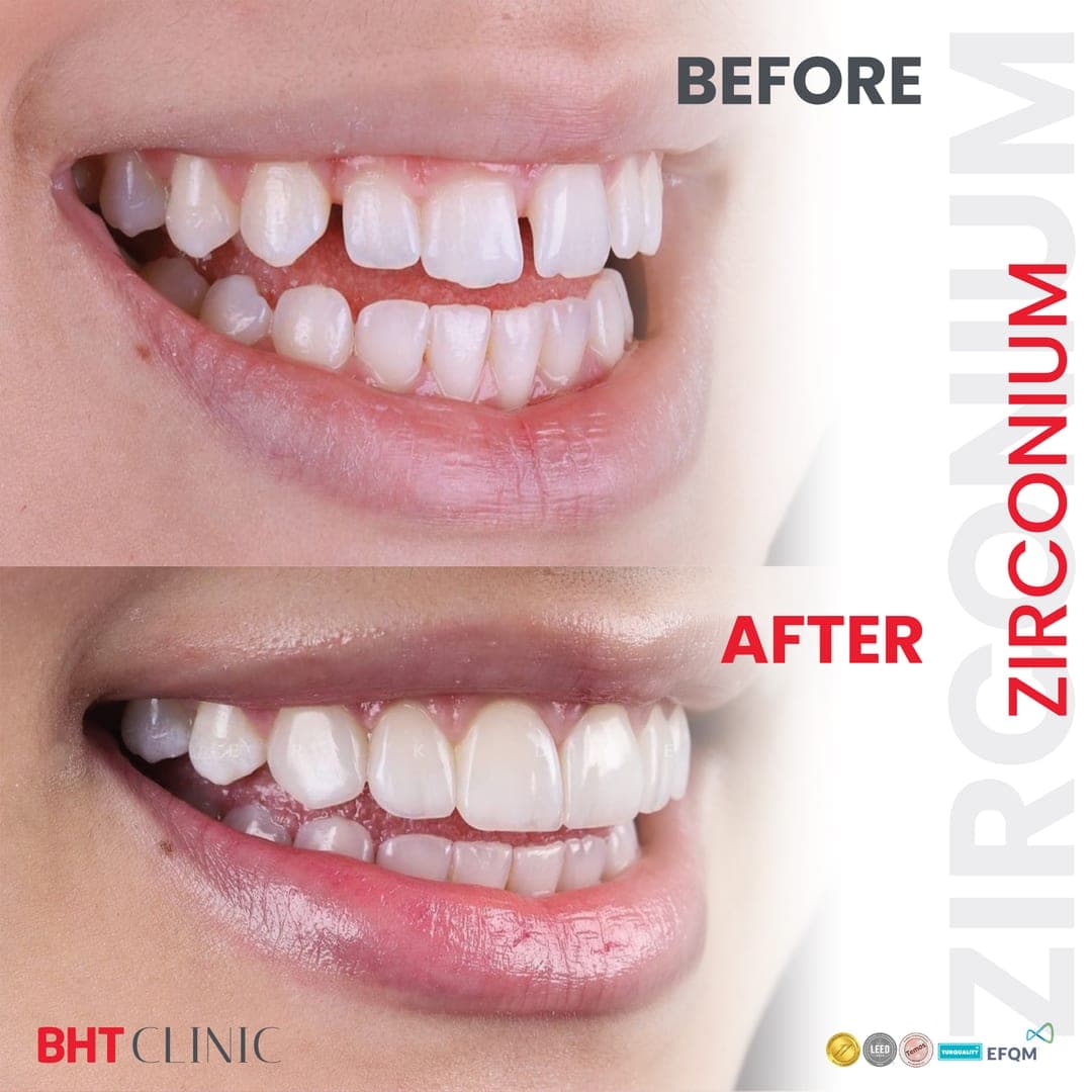 Front teeth — gaps closed and edges evened — before and after, photo 1