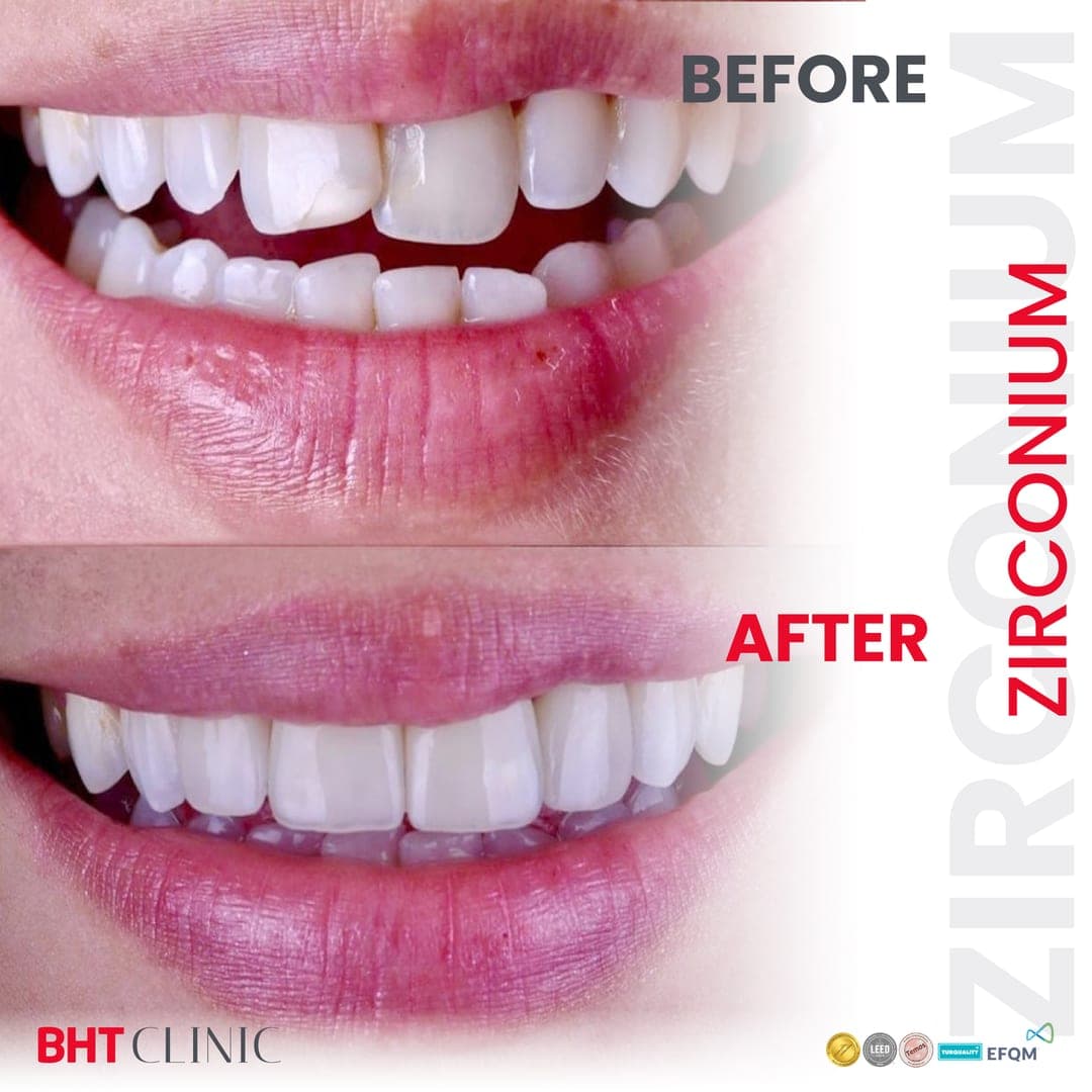 Front teeth — chipped incisors restored — before and after, photo 1