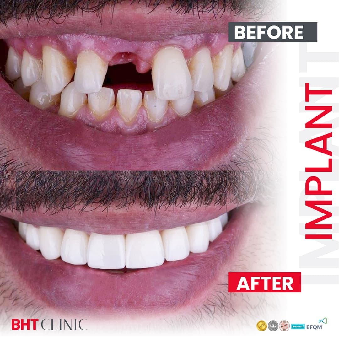 Missing front tooth — full-mouth restoration — before and after, photo 1