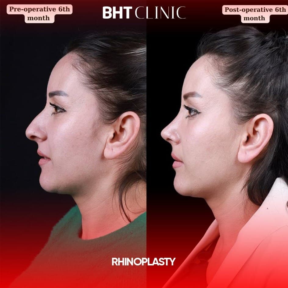Profile, at six months — before and after, photo 1