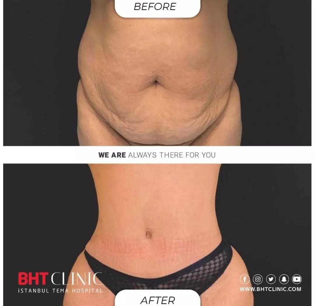 Loose skin after weight loss — before and after, photo 1